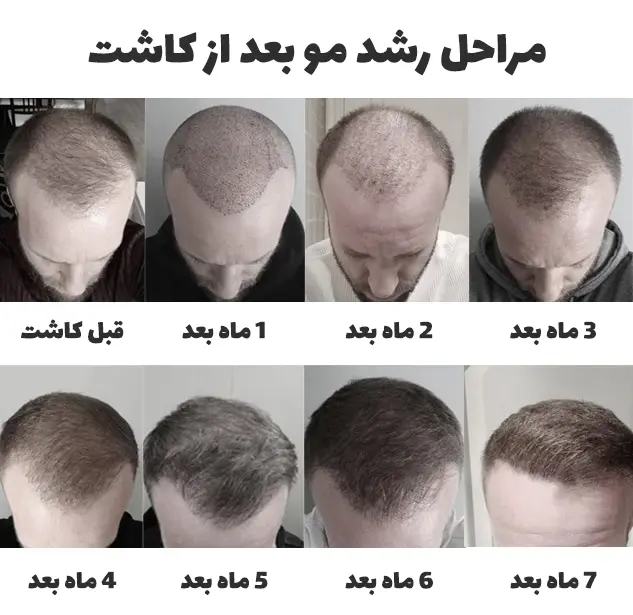 عکس مراحل رشد مو بعد از کاشت