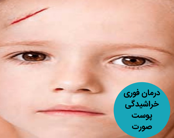 درمان فوری خراشیدگی پوست صورت