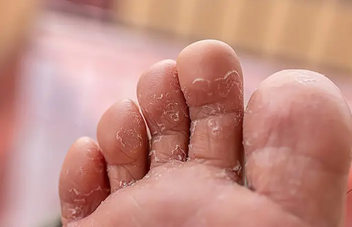 تینه&zwnj;آ پدیس (پای ورزشکار)