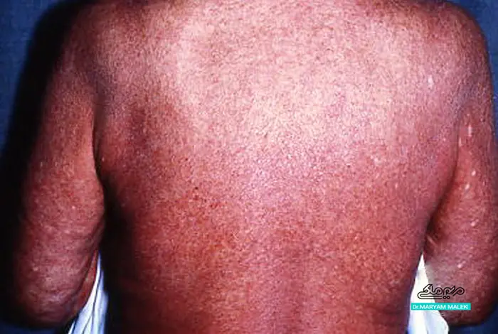 مایکوزیس فونگوئیدس (نوع نادر و بدخیم)