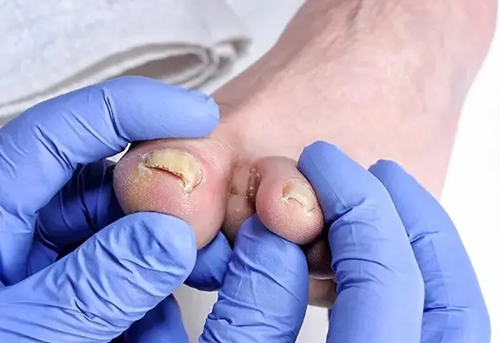 تینه‌آ اونگوئیوم (قارچ ناخن)