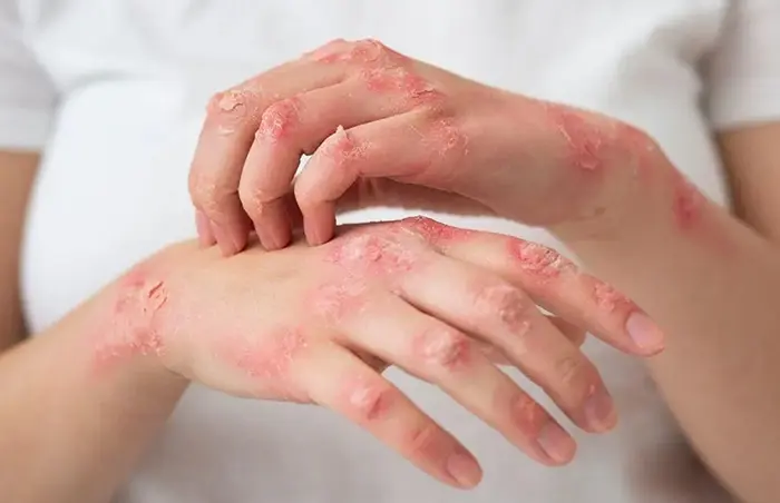 تینه‌آ کورپوریس